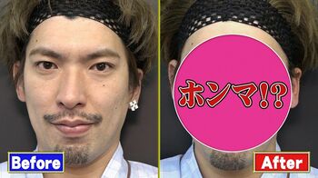 りんたろー。、オカリナ、磯野貴理子が 最新美容整形法「ハイフ」に挑戦！その効果は？