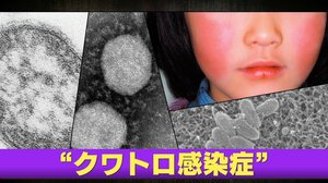 【クワトロ感染症】新型コロナ・リンゴ病・はしか・百日ぜき流行　新型コロナは感染者数が8週連続で増加…要因は「猛烈な暑さと夏休み」