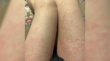 10代～30代が特に多い「寒冷じんましん」慢性化の恐れも…対策法は？