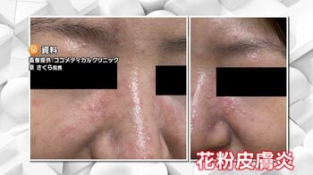 肌のかゆみと赤みは「花粉皮膚炎」かも？　眠れないほどかゆくなることも