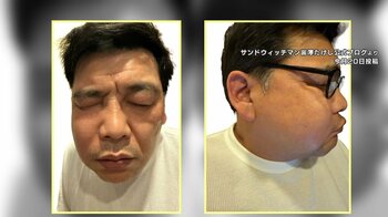 サンドウィッチマン・富澤たけし（50）顔が腫れ上がり痛々しい姿に…副鼻腔炎原因 花粉や黄砂でリスク上昇
