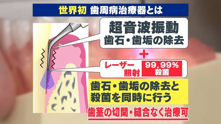 世界初】「歯周病」の治療器が日本で承認 99.99％殺菌！？ お