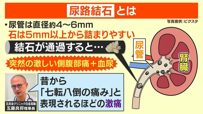 注意】猛暑で「尿路結石」の患者が急増！理由は“脱水” 谷原章介も3年前
