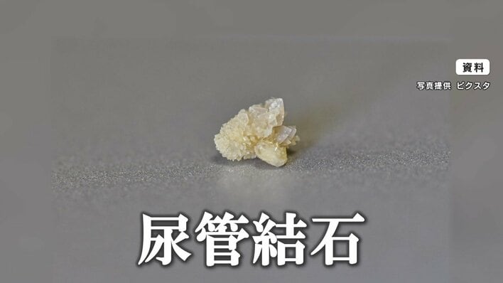 注意】猛暑で「尿路結石」の患者が急増！理由は“脱水” 谷原章介も3年前
